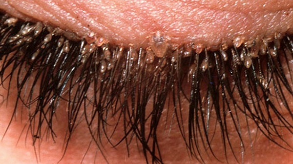 acariens extension de cils