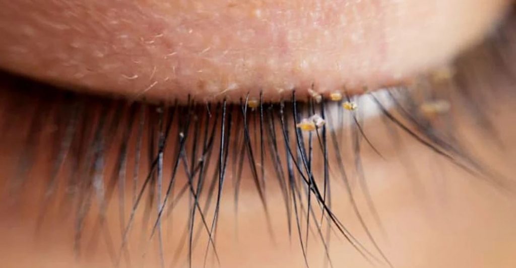 poux extension de cils